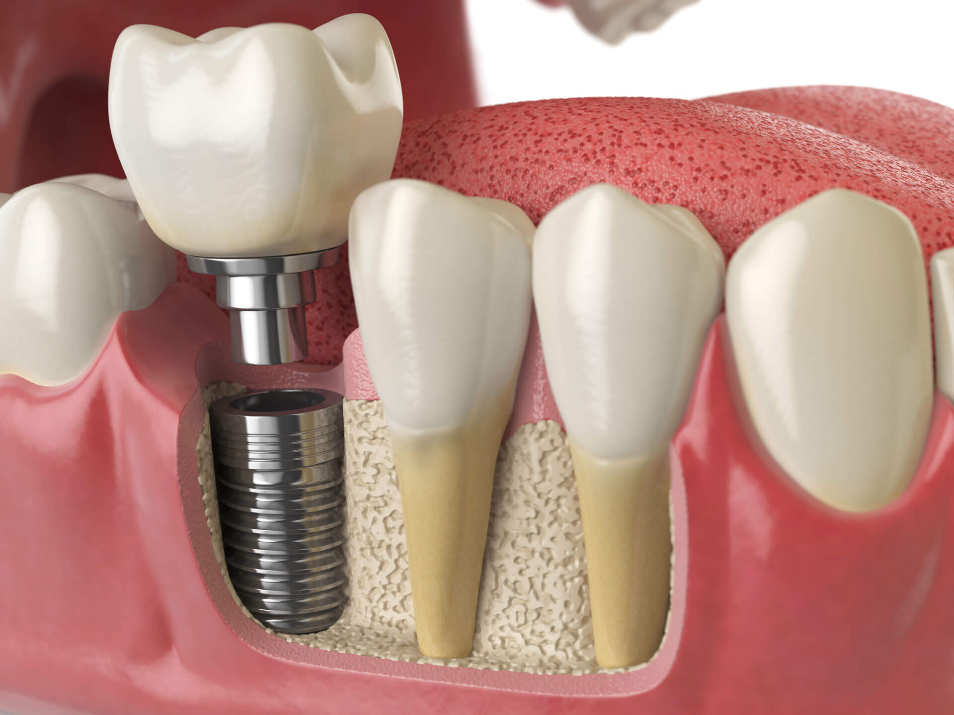 Dental implants