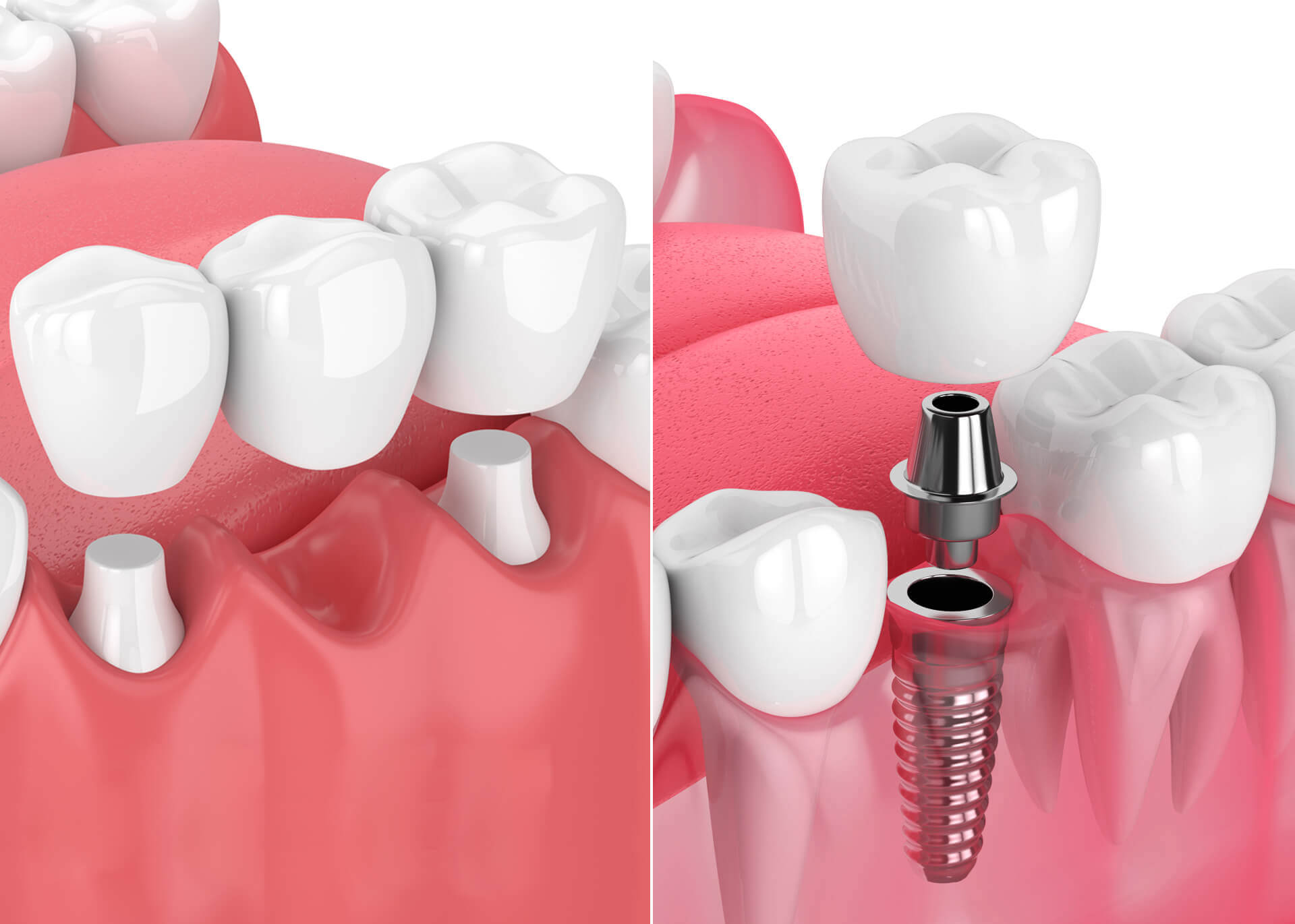 dental implants rather than bridges