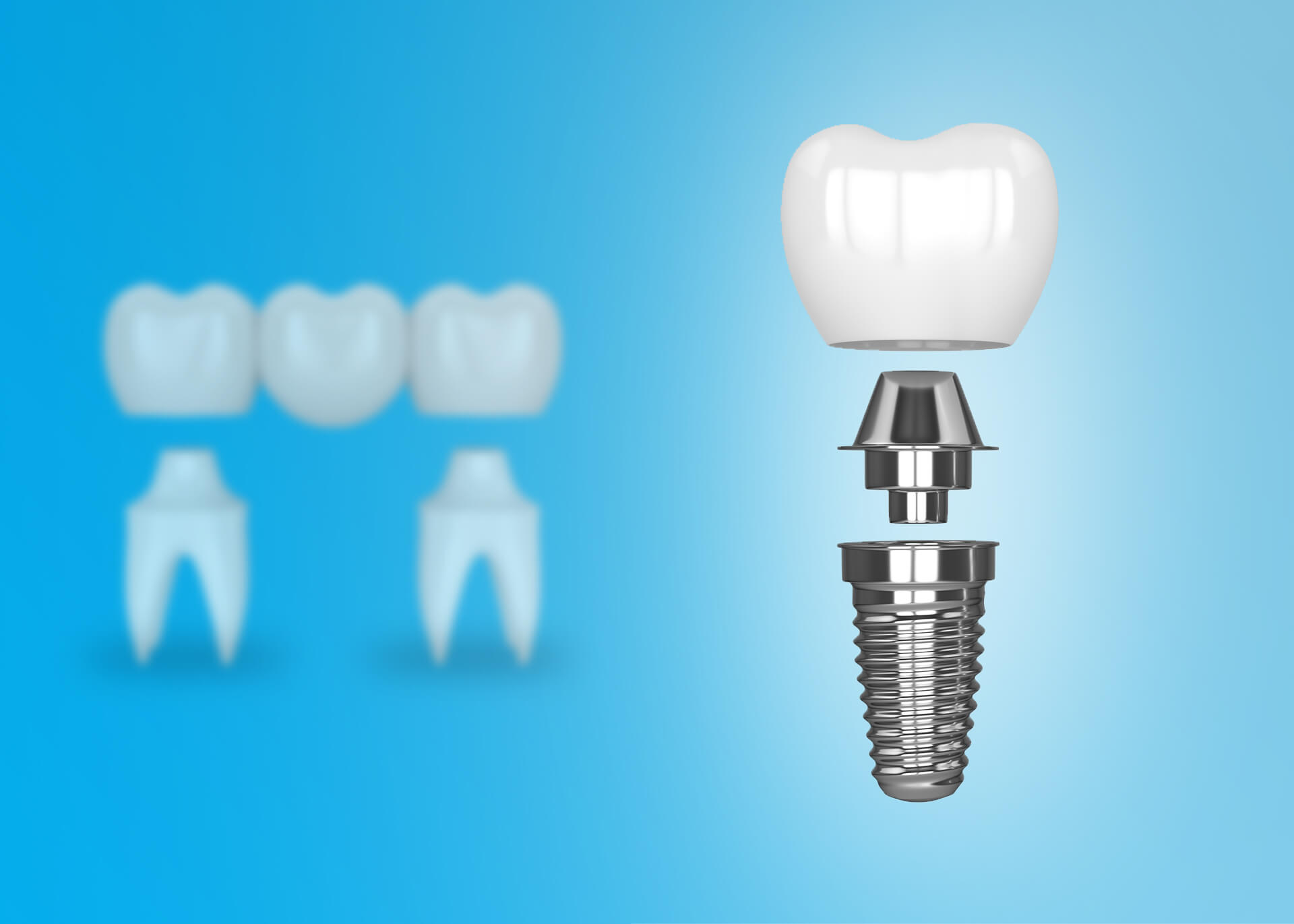 get a dental implant