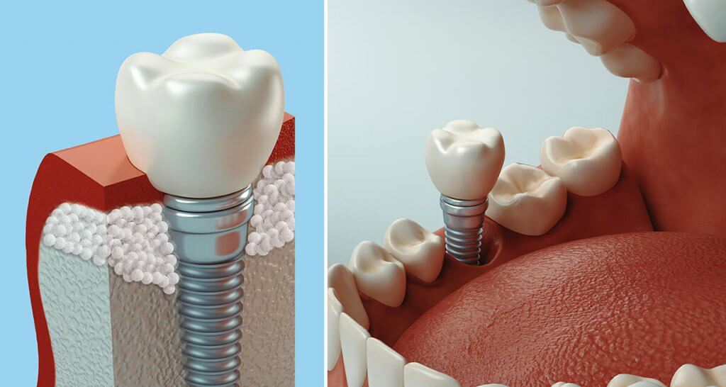 Dental Bone Grafting VitalEurope Dental Clinic Treatment dental-bone-grafting-vitaleurope-dental-clinic-treatment