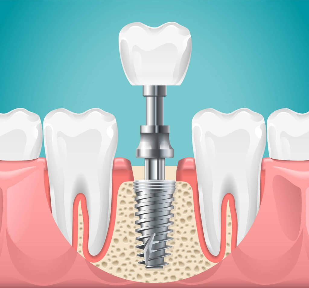 ental implants