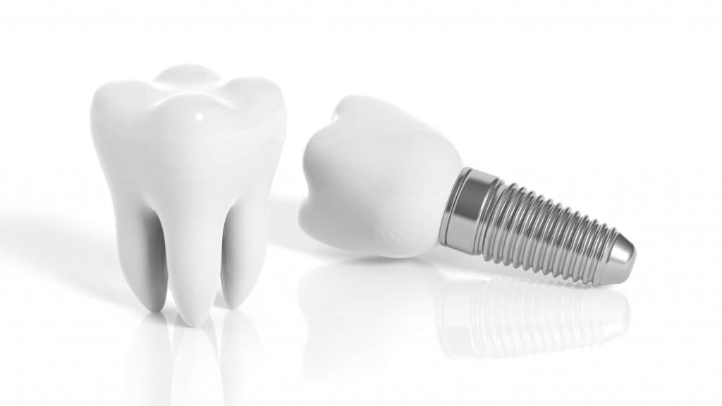 dental implant and tooth