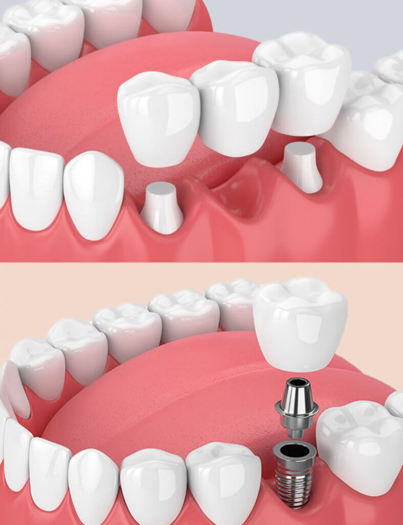 dental implants 3
