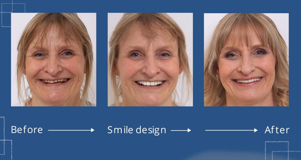 before after smile design