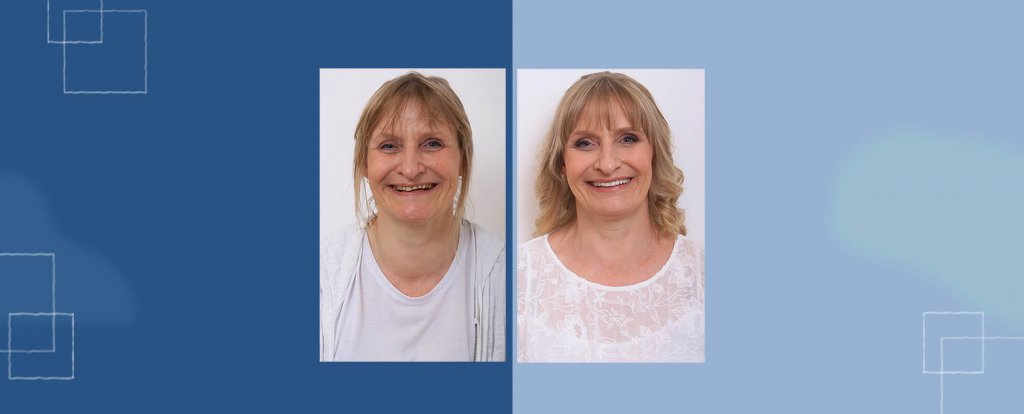 before after smile makeover