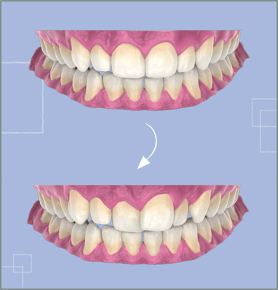 dental plaque 3