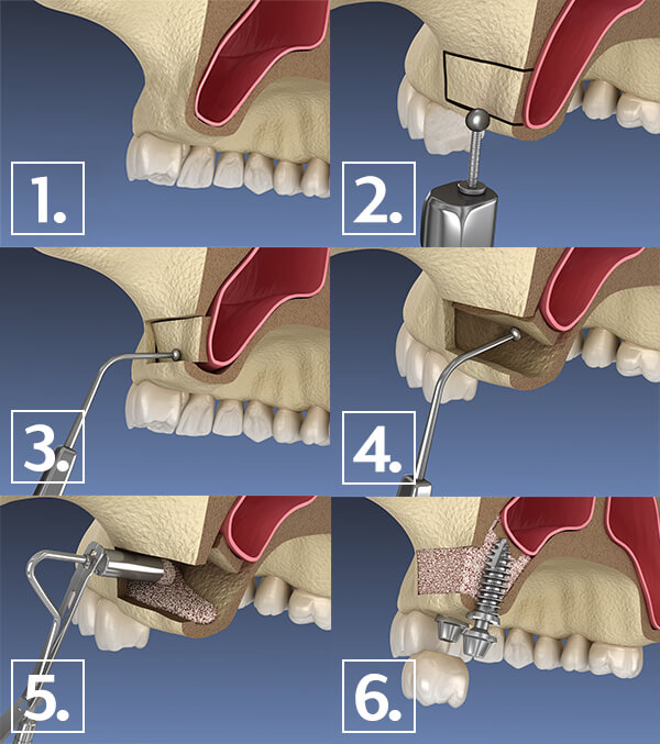 sinus lift