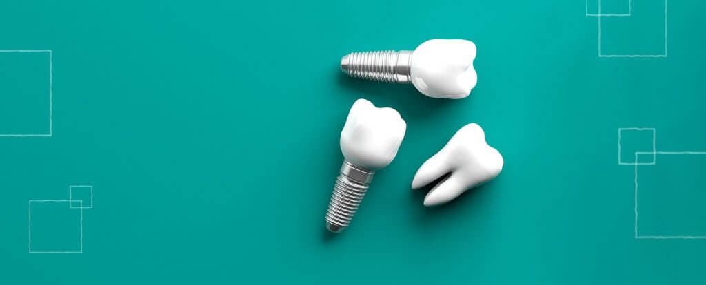 misconceptions dental implants