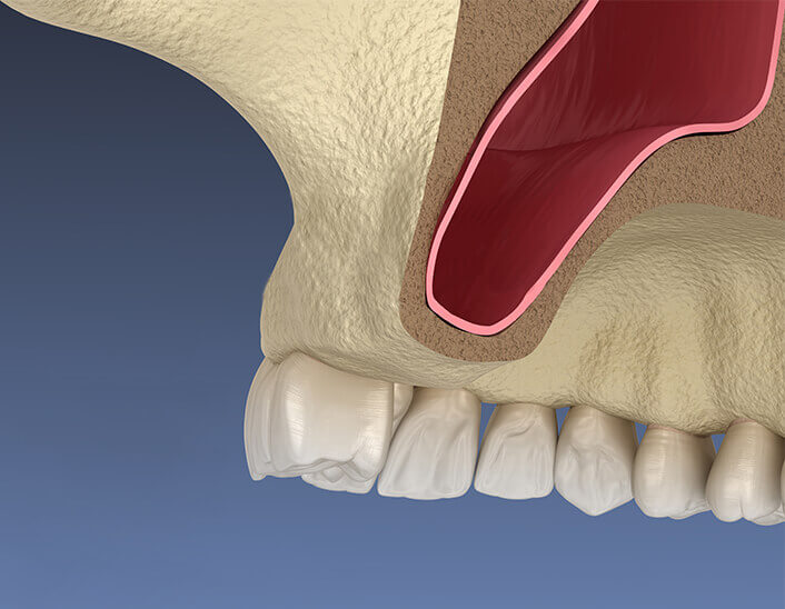 sinus lift