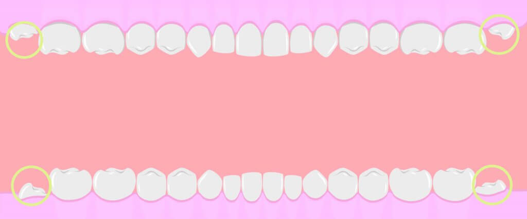 wisdom tooth positions