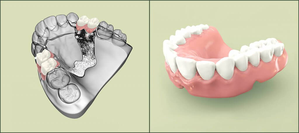 removable dentures