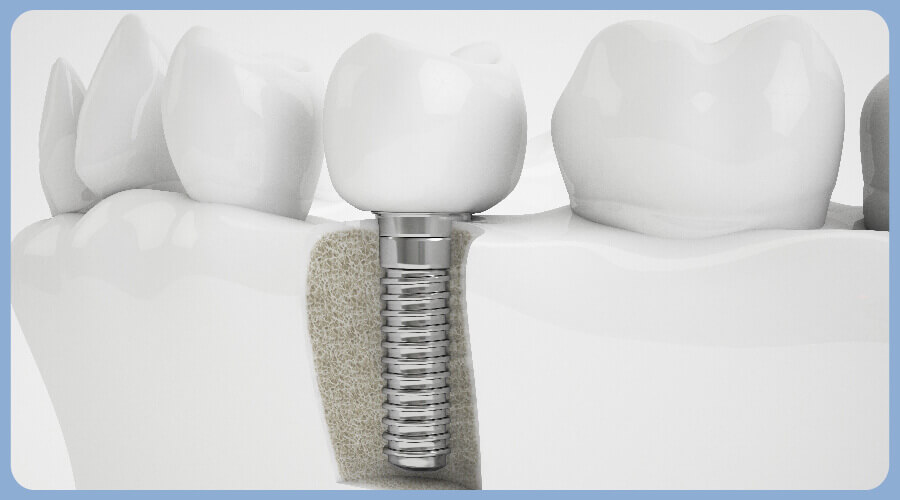 dental implant