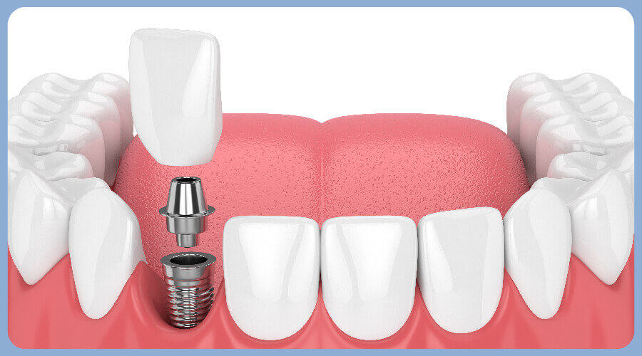 dental implant