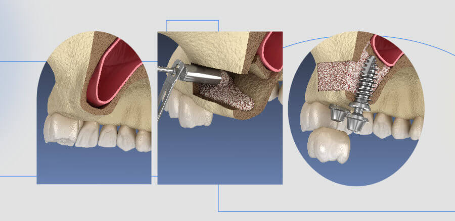 dental implant