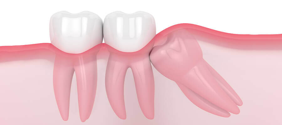 wisdom tooth extraction