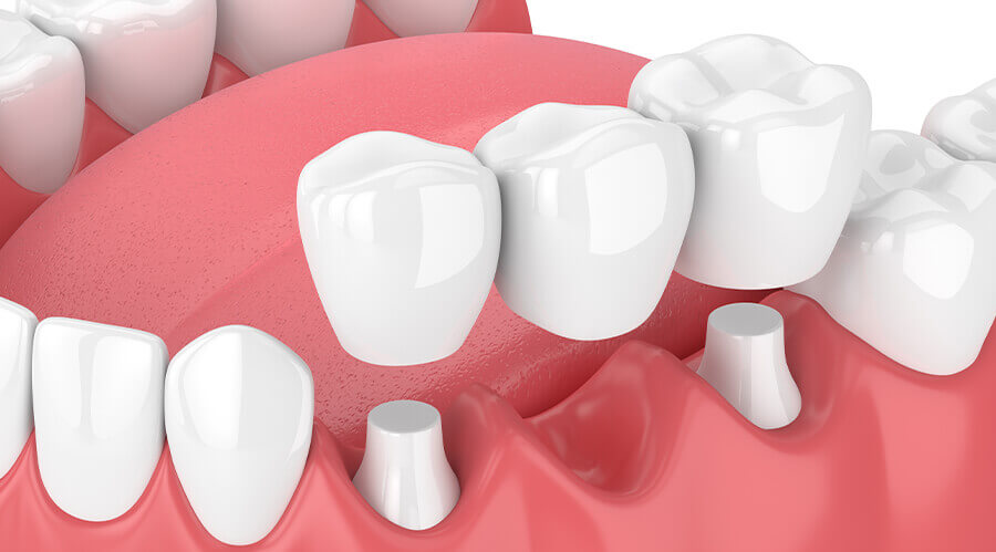 dental bridge