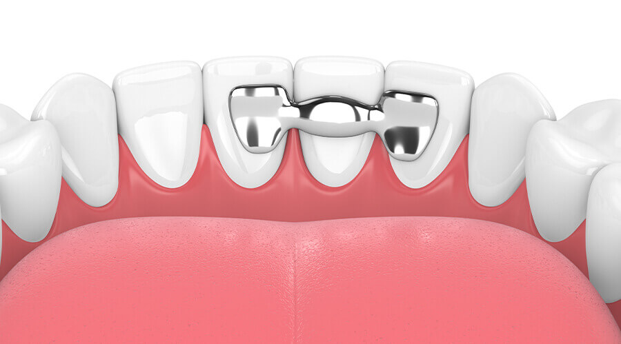 dental bridge