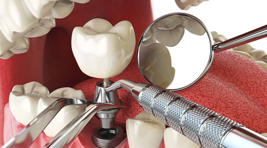 dental implant