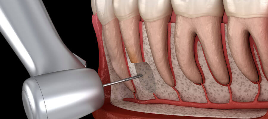 root apex resection