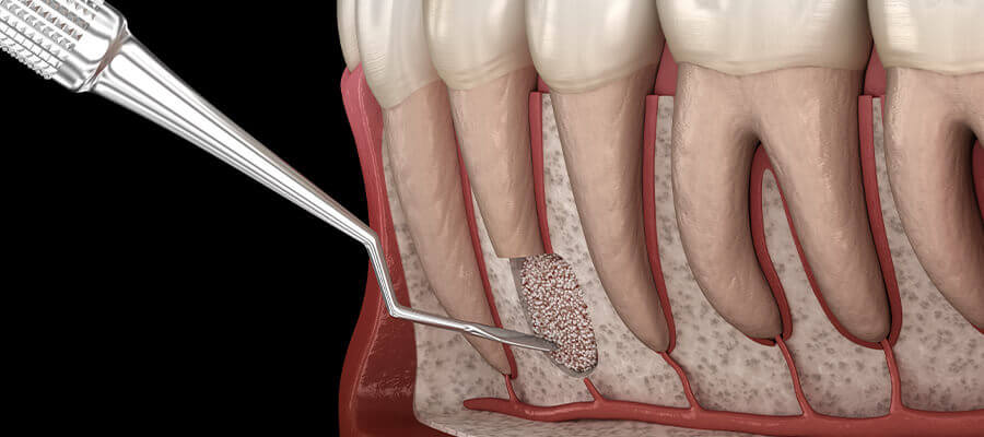 root apex resection (3)