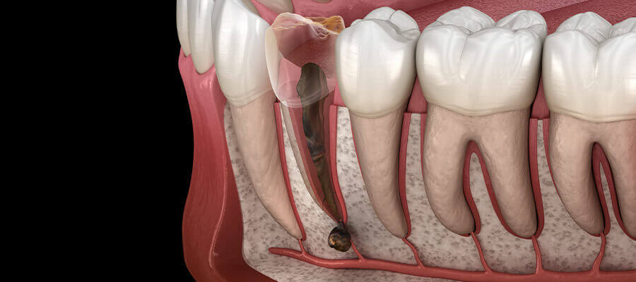 root apex resection