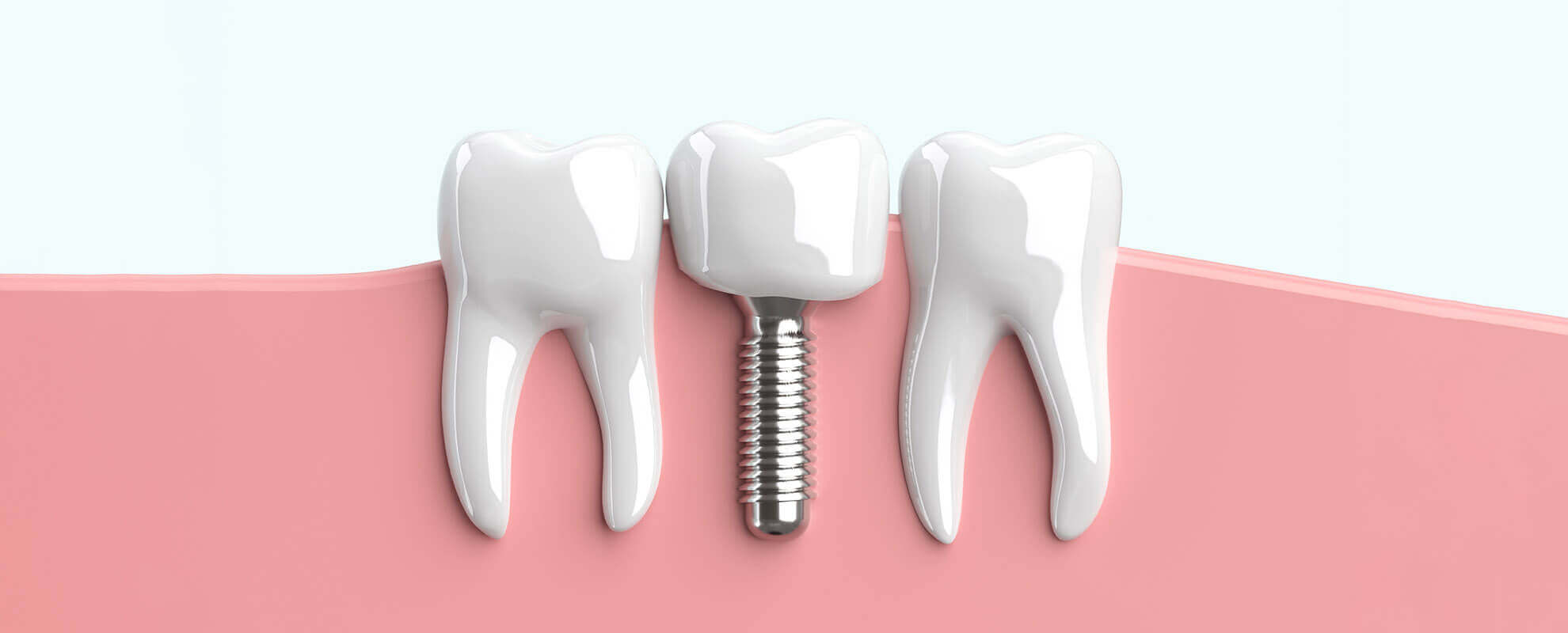 dental implant